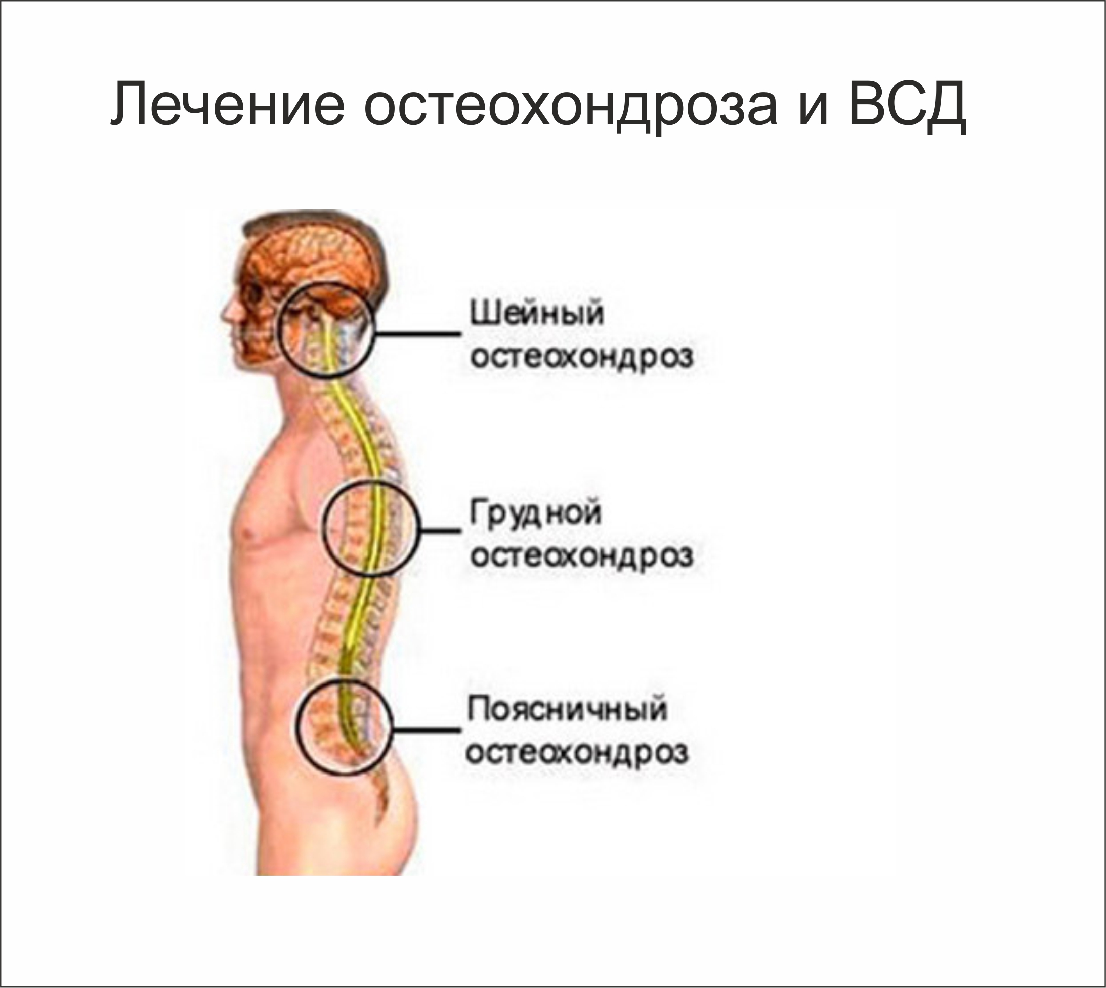 Грудной остеохондроз схема лечения Грудной остеохондроз схема лечения